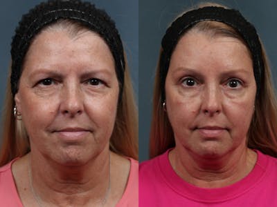 Brow/Forehead Lift Before & After Gallery - Patient 121687 - Image 1