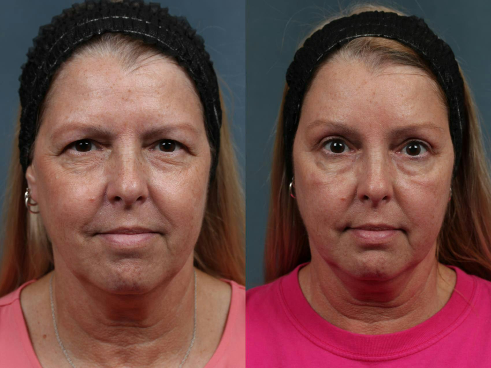 Brow/Forehead Lift Before & After Gallery - Patient 121687 - Image 1