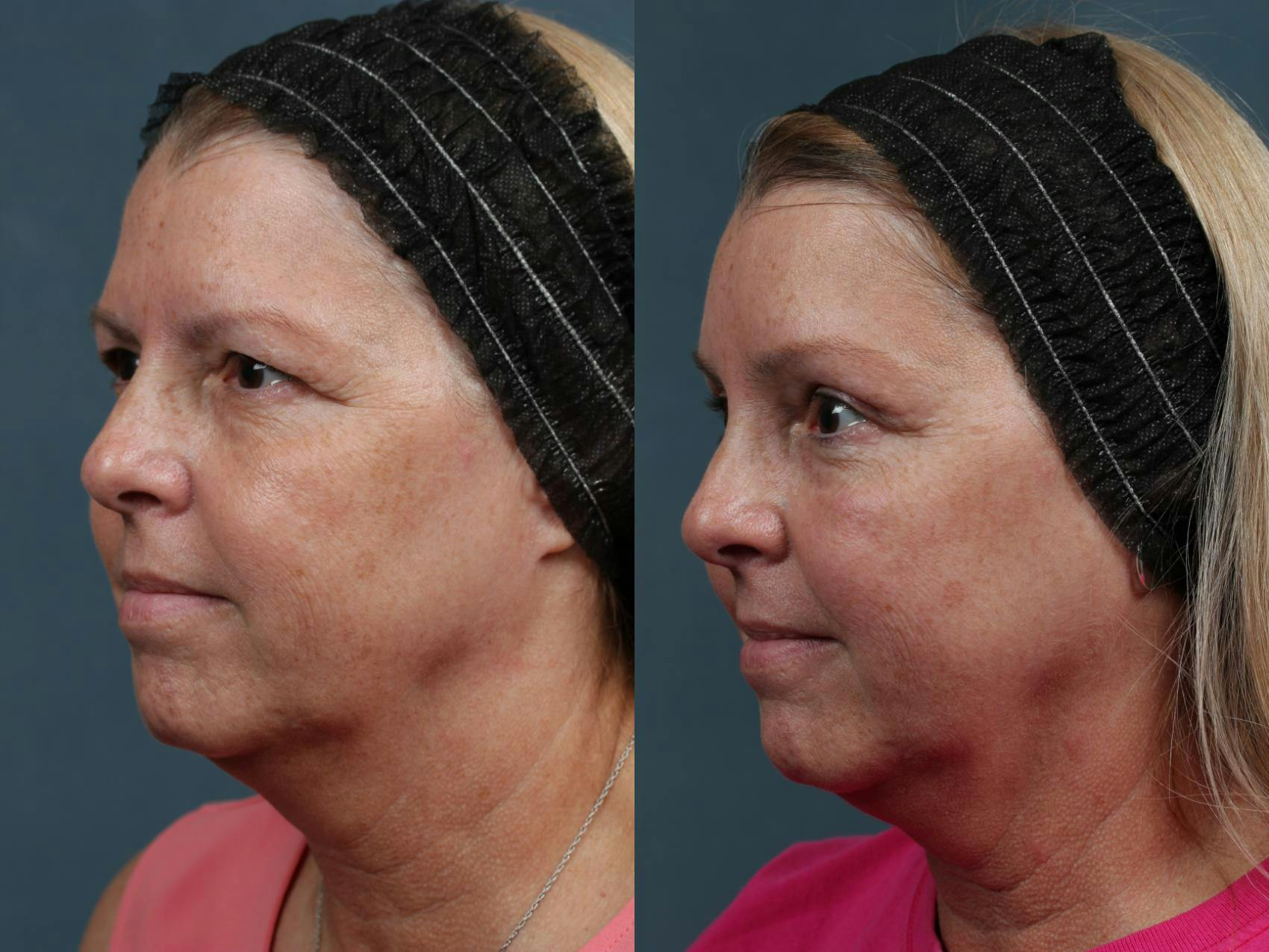 Brow/Forehead Lift Before & After Gallery - Patient 121687 - Image 2