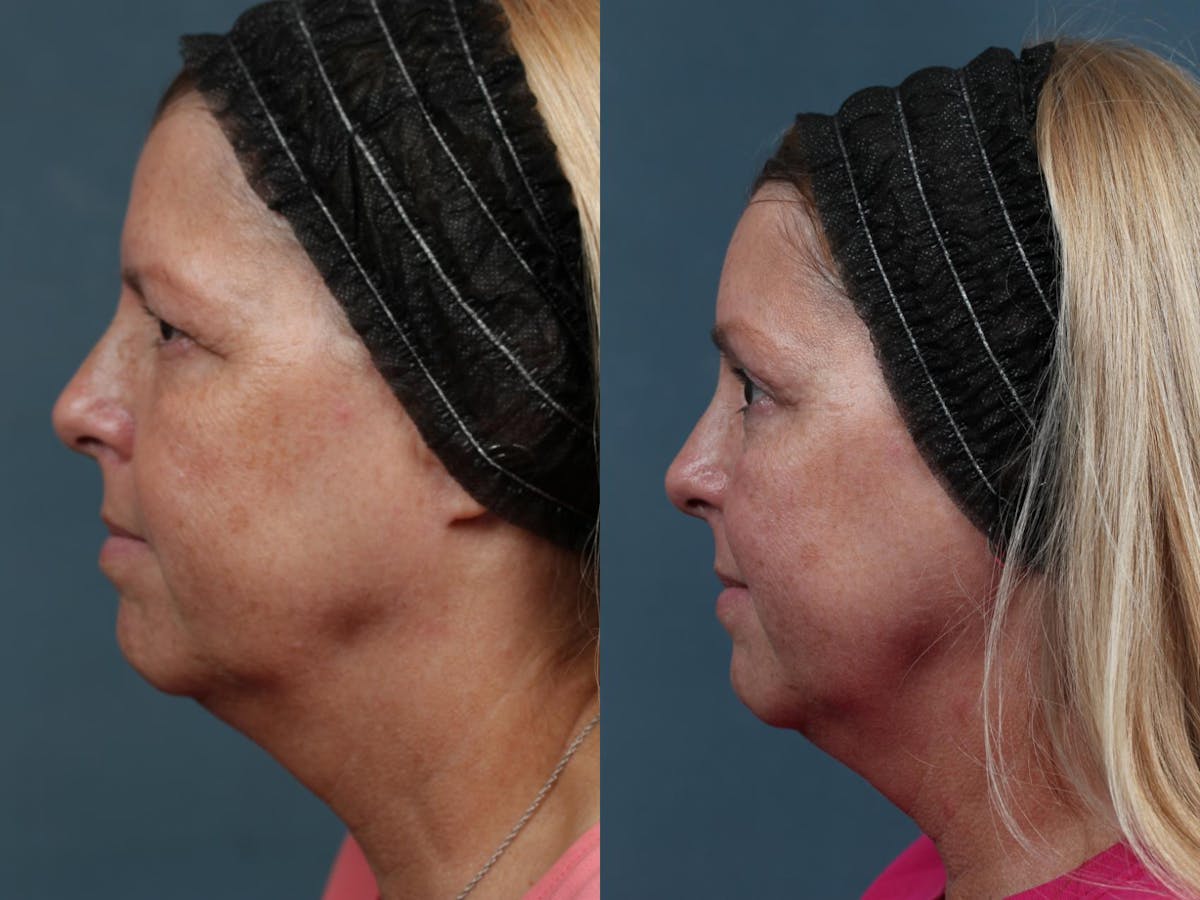 Brow/Forehead Lift Before & After Gallery - Patient 121687 - Image 3