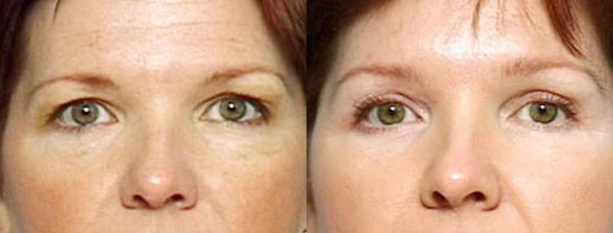 Brow/Forehead Lift Before & After Gallery - Patient 134522 - Image 1