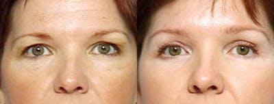 Brow/Forehead Lift Before & After Gallery - Patient 134522 - Image 1