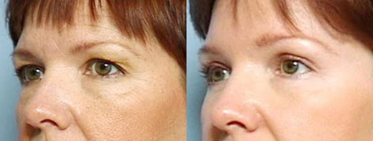 Brow/Forehead Lift Before & After Gallery - Patient 134522 - Image 2