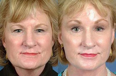 Brow/Forehead Lift Before & After Gallery - Patient 254198 - Image 1