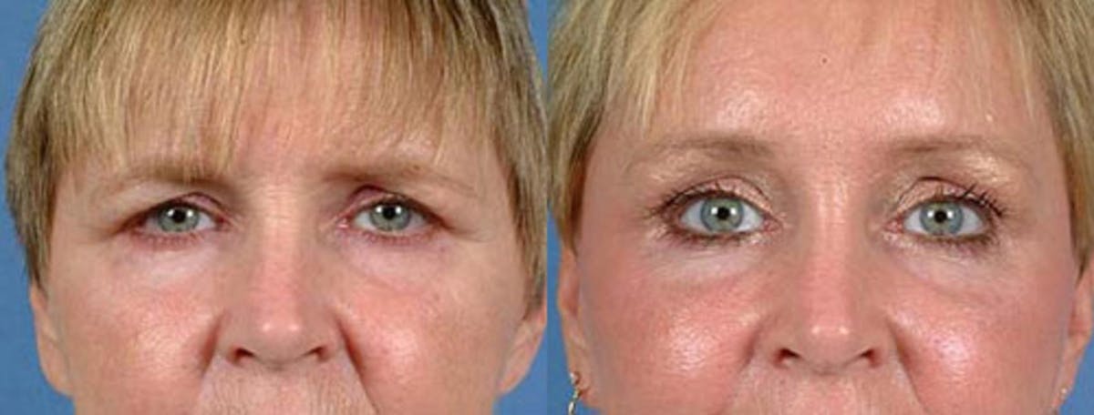 Brow/Forehead Lift Before & After Gallery - Patient 172704 - Image 1