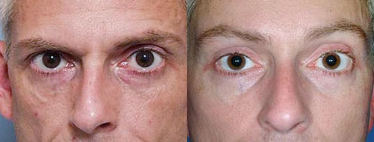 Brow/Forehead Lift Before & After Gallery - Patient 274602 - Image 1