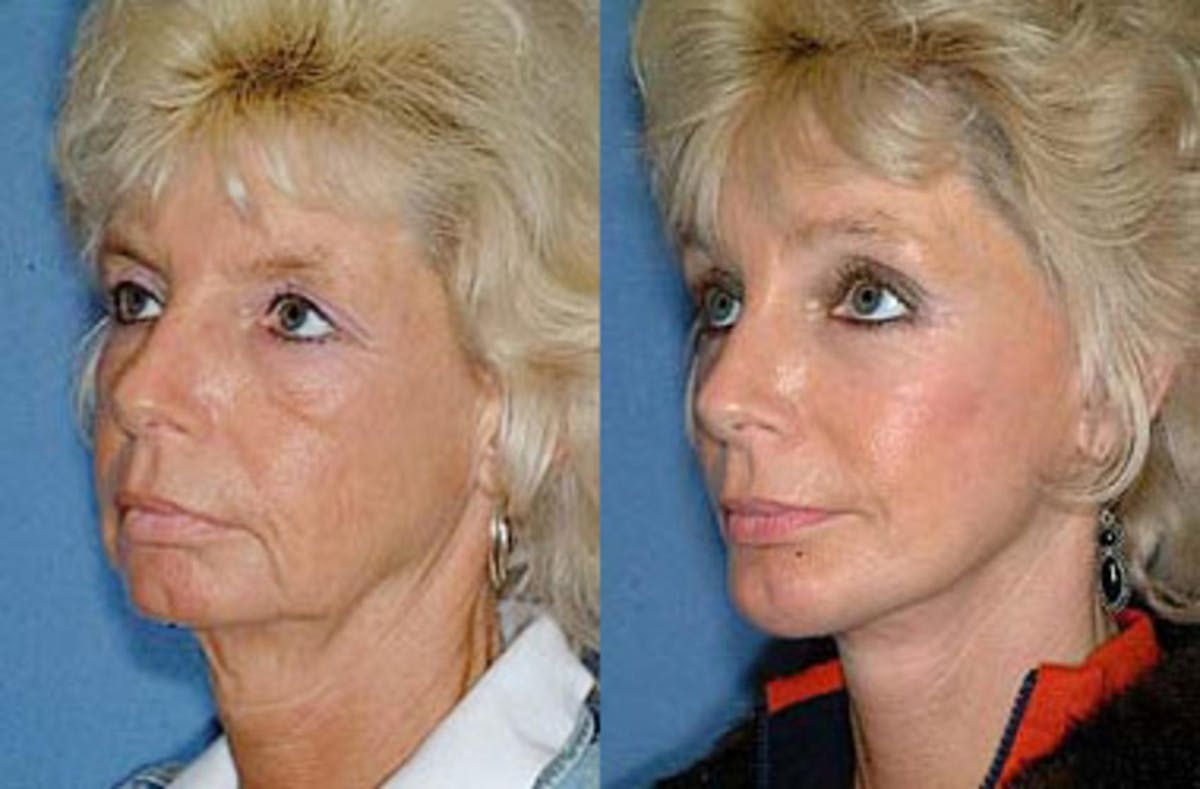 Brow/Forehead Lift Before & After Gallery - Patient 382926 - Image 2