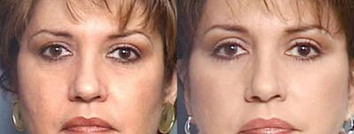 Brow/Forehead Lift Before & After Gallery - Patient 144004 - Image 1