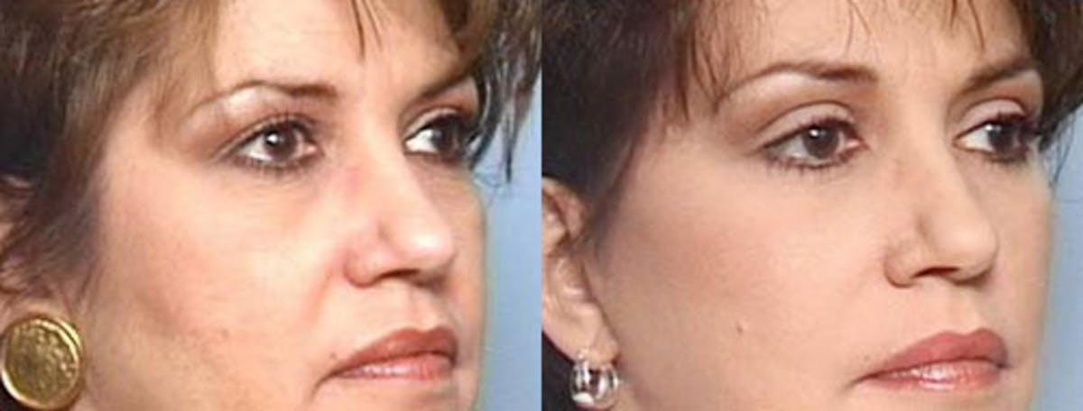Brow/Forehead Lift Before & After Gallery - Patient 144004 - Image 2
