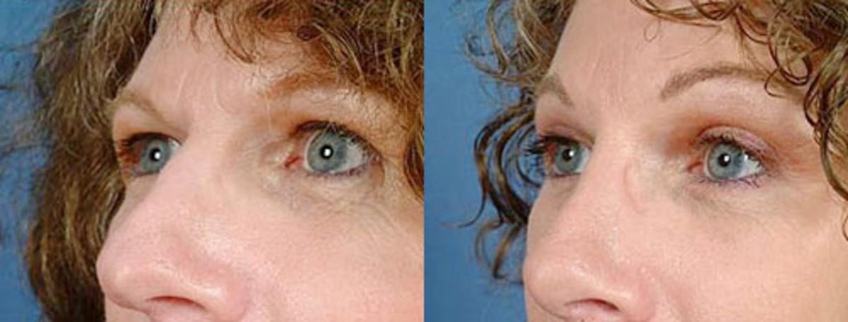 Brow/Forehead Lift Before & After Gallery - Patient 297246 - Image 2