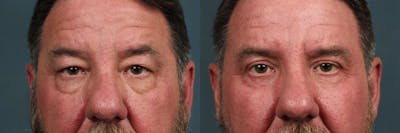 Eyelid Surgery Before & After Gallery - Patient 242277 - Image 1