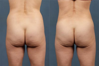 Fat Transfer Before & After Gallery - Patient 200100 - Image 1