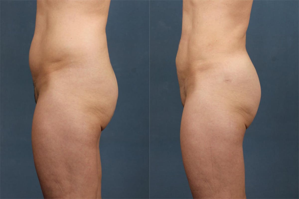 Fat Transfer Before & After Gallery - Patient 200100 - Image 3