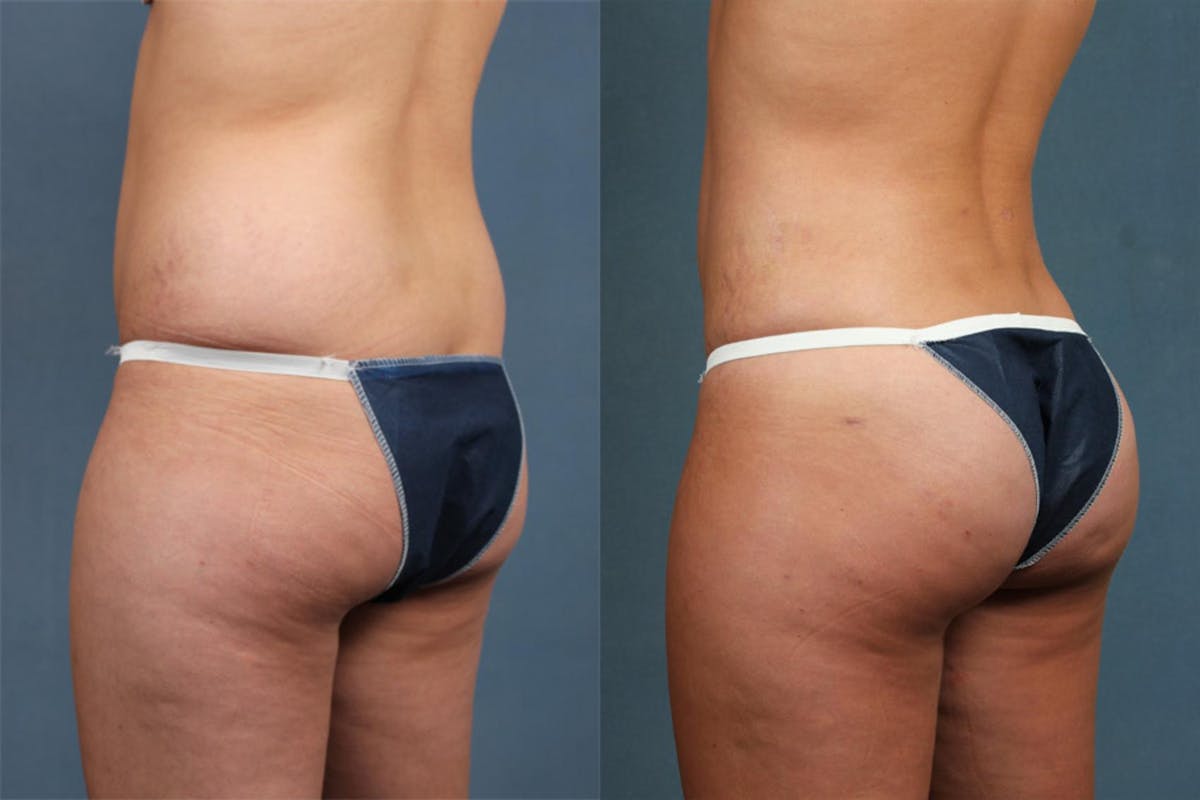 Brazilian Butt Lift Before & After Gallery - Patient 194194 - Image 2