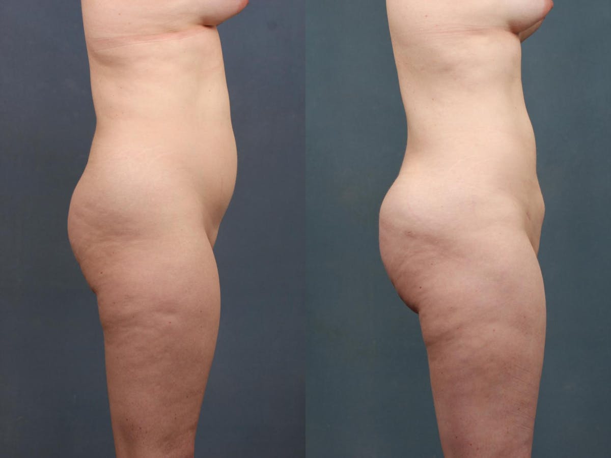 Brazilian Butt Lift Before & After Gallery - Patient 101004 - Image 3