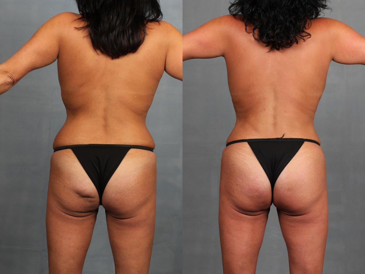 Brazilian Butt Lift Before & After Gallery - Patient 379705 - Image 1