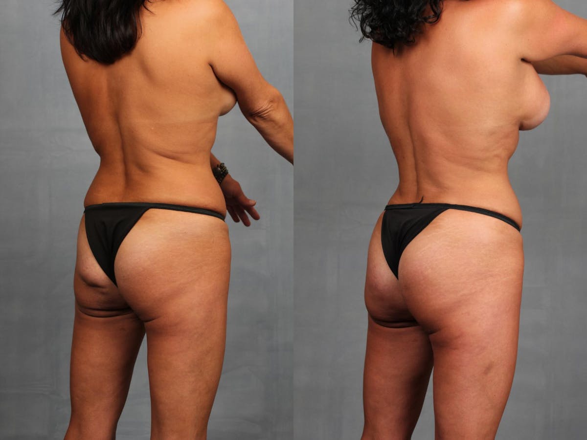 Brazilian Butt Lift Before & After Gallery - Patient 379705 - Image 2