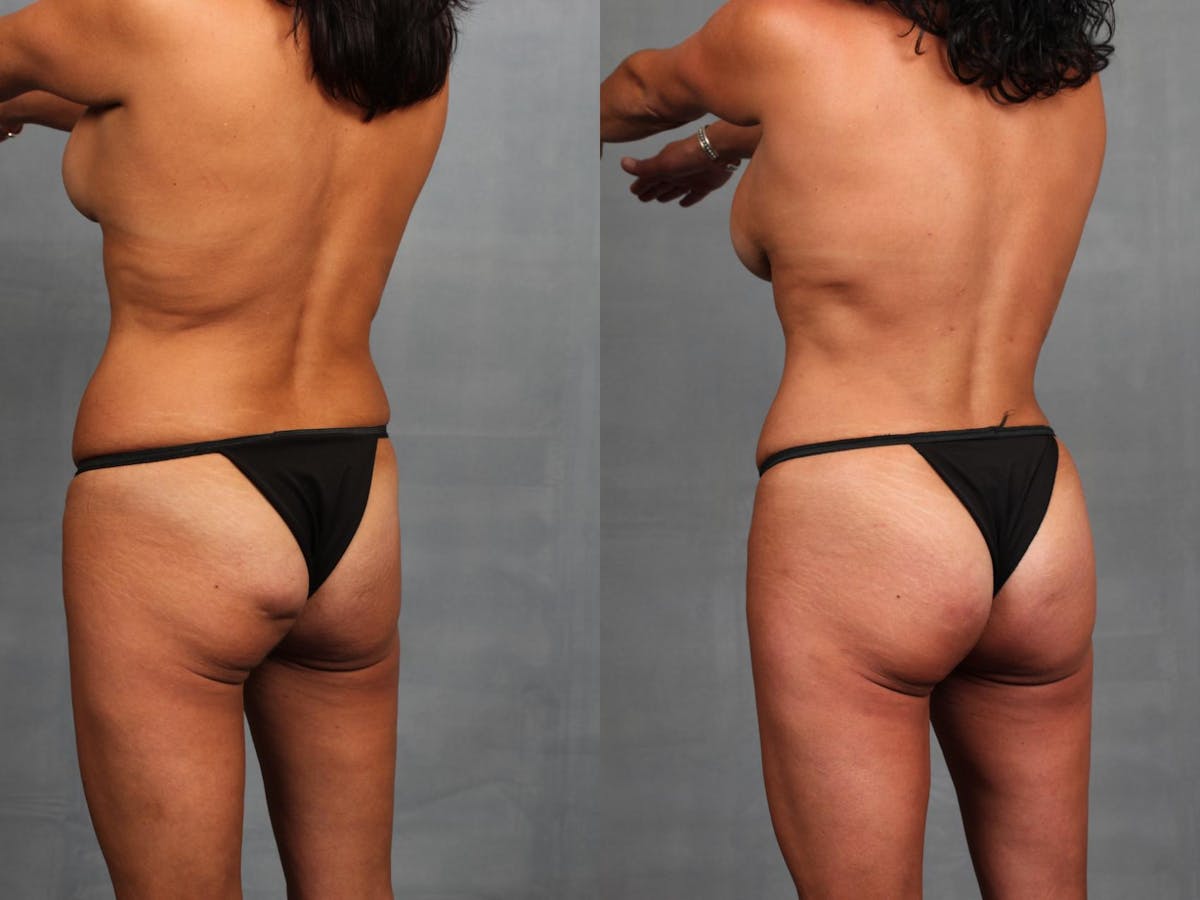 Brazilian Butt Lift Before & After Gallery - Patient 379705 - Image 3
