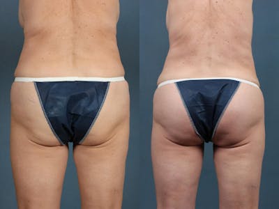 Brazilian Butt Lift Before & After Gallery - Patient 198141 - Image 1