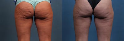 Cellulite Treatments Before & After Gallery - Patient 156321 - Image 1