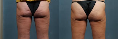 Cellulite Treatments Before & After Gallery - Patient 288815 - Image 1