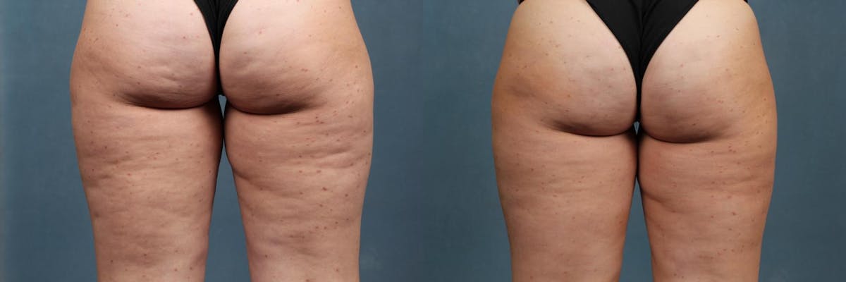 Cellulite Treatments Before & After Gallery - Patient 362930 - Image 1