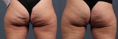 Cellulite Treatments Before & After Gallery - Patient 422789 - Image 1