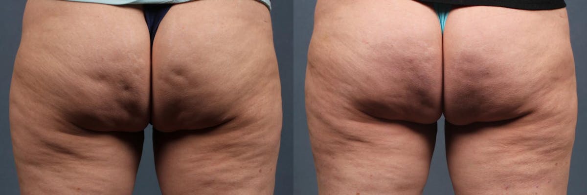 Cellulite Treatments Before & After Gallery - Patient 325475 - Image 1