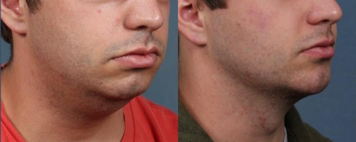 Chin Augmentation Before & After Gallery - Patient 238297 - Image 1