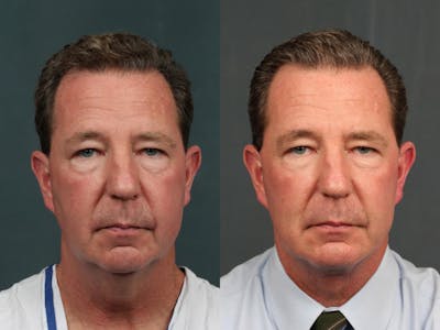 Chin Augmentation Before & After Gallery - Patient 121756 - Image 1