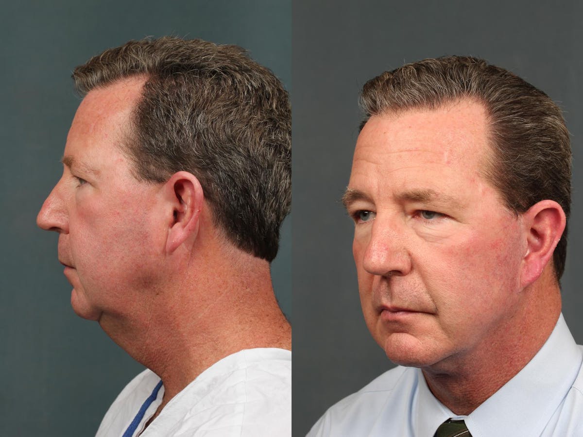 Chin Augmentation Before & After Gallery - Patient 192663 - Image 2