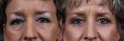 Eyelid Surgery Before & After Gallery - Patient 171275 - Image 1