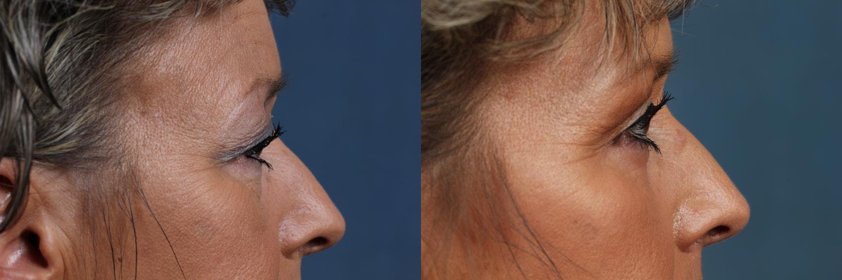 Eyelid Surgery Before & After Gallery - Patient 171275 - Image 2
