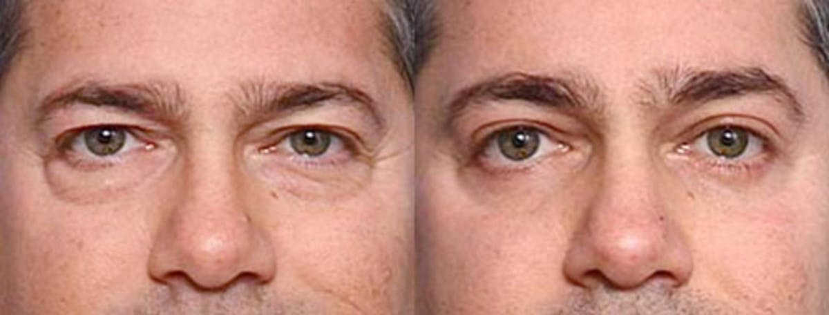 Eyelid Surgery Before & After Gallery - Patient 181394 - Image 1