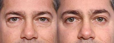 Eyelid Surgery Before & After Gallery - Patient 181394 - Image 1