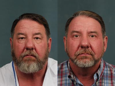 Eyelid Surgery Before & After Gallery - Patient 175199 - Image 1