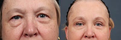 Eyelid Surgery Before & After Gallery - Patient 144281 - Image 1