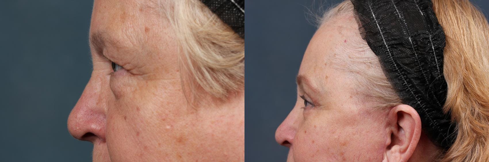 Eyelid Surgery Before & After Gallery - Patient 144281 - Image 3