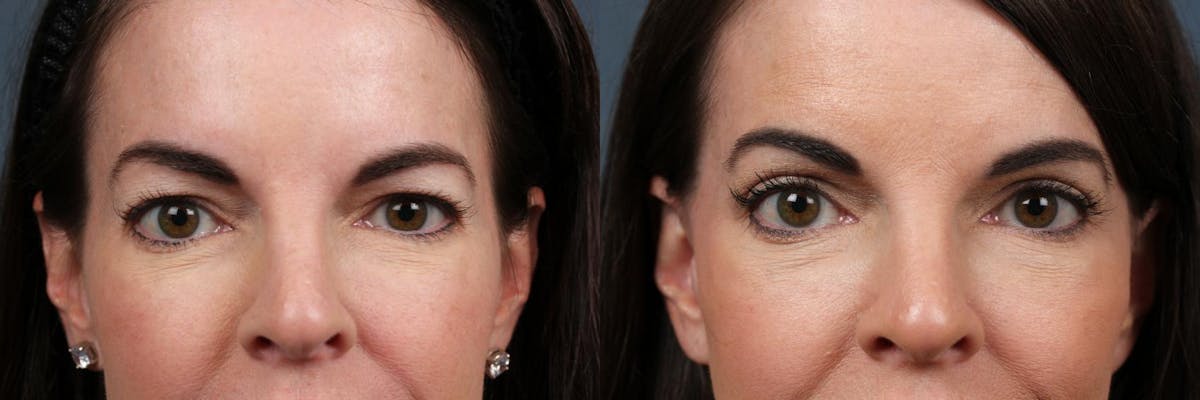 Eyelid Surgery Before & After Gallery - Patient 341452 - Image 1