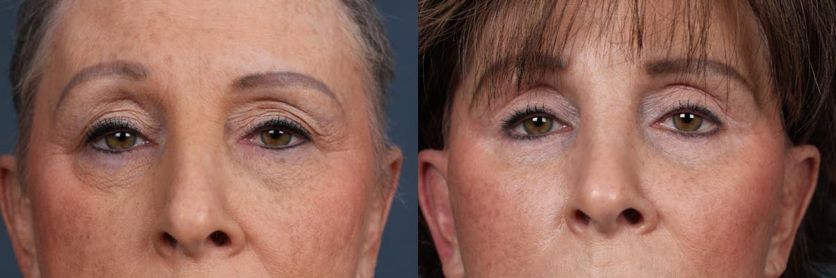 Eyelid Surgery Before & After Gallery - Patient 180269 - Image 4