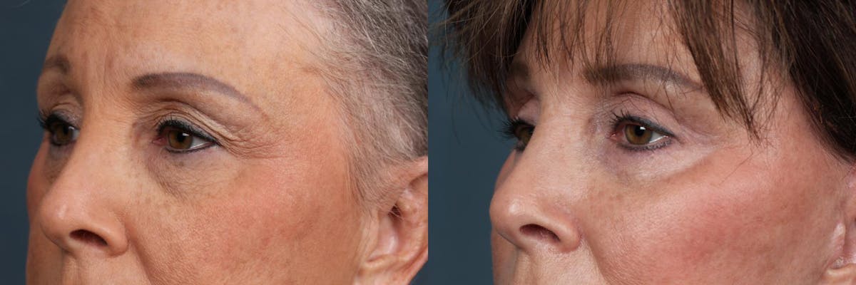 Eyelid Surgery Before & After Gallery - Patient 180269 - Image 5