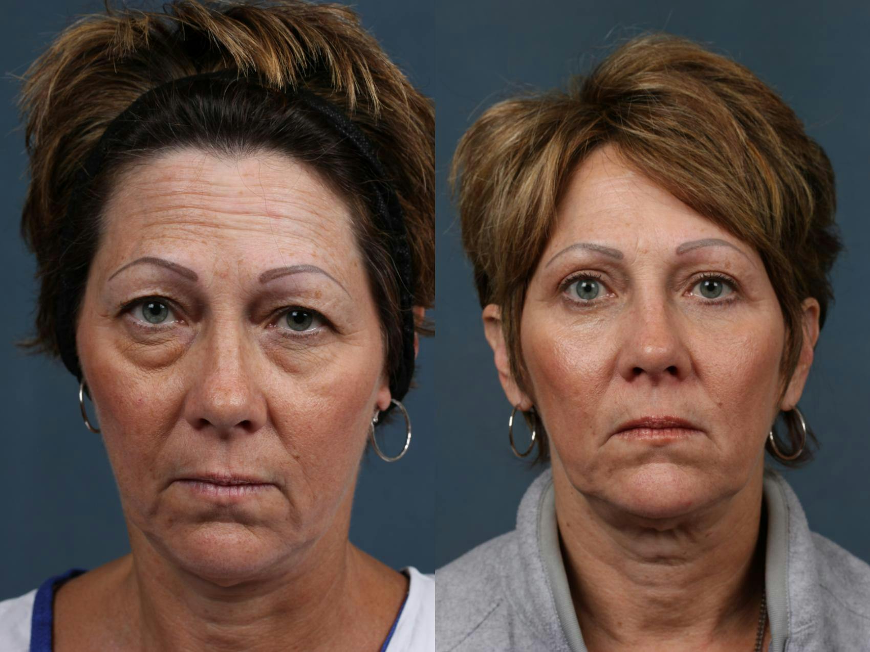 Eyelid Surgery Before & After Gallery - Patient 220080 - Image 1