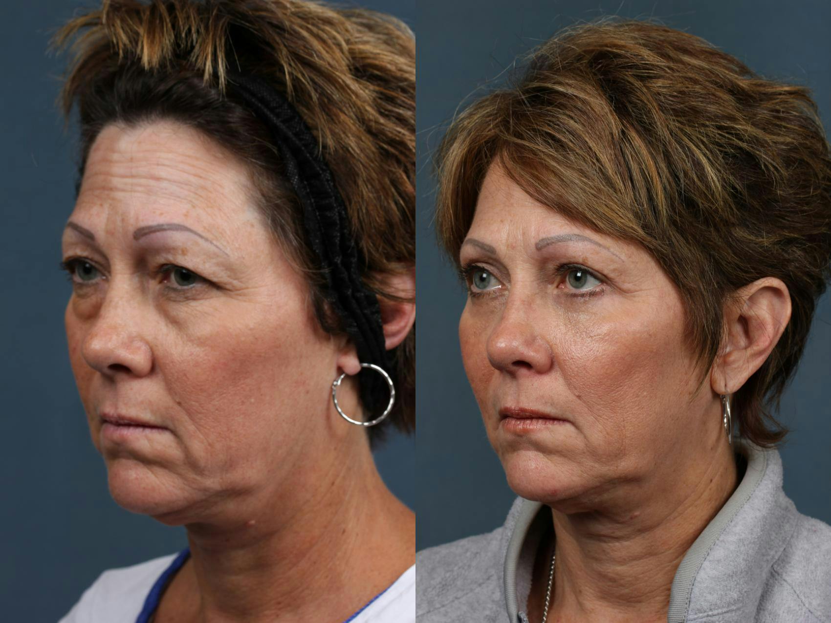 Eyelid Surgery Before & After Gallery - Patient 220080 - Image 2