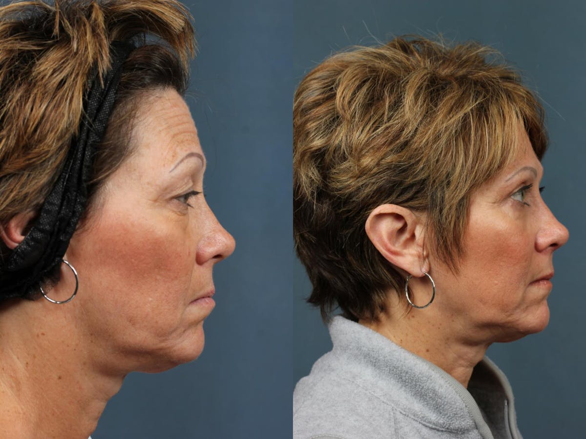 Eyelid Surgery Before & After Gallery - Patient 220080 - Image 3