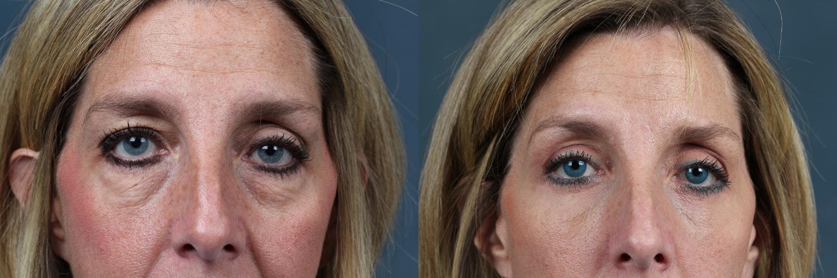 Eyelid Surgery Before & After Gallery - Patient 196118 - Image 1