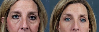 Eyelid Surgery Before & After Gallery - Patient 196118 - Image 1