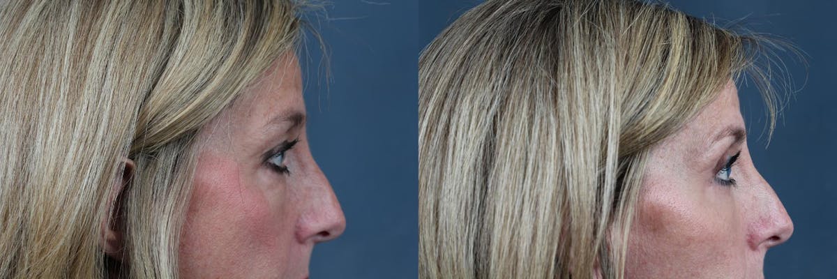 Eyelid Surgery Before & After Gallery - Patient 196118 - Image 2