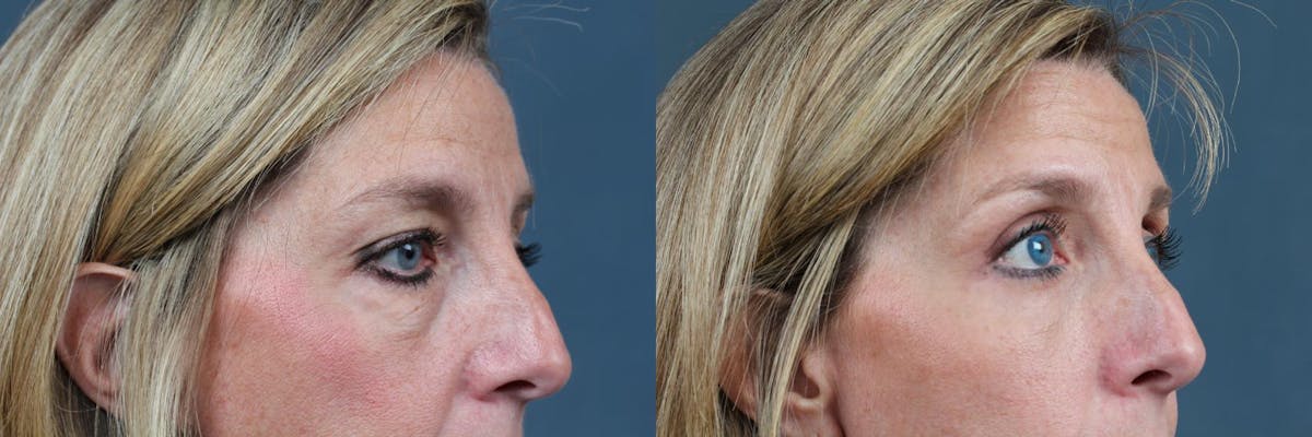 Eyelid Surgery Before & After Gallery - Patient 196118 - Image 3
