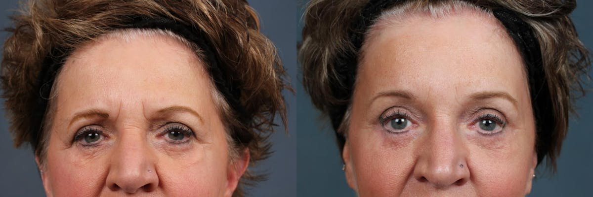 Eyelid Surgery Before & After Gallery - Patient 416206 - Image 1