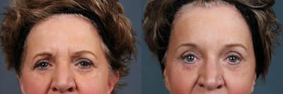 Eyelid Surgery Before & After Gallery - Patient 416206 - Image 1